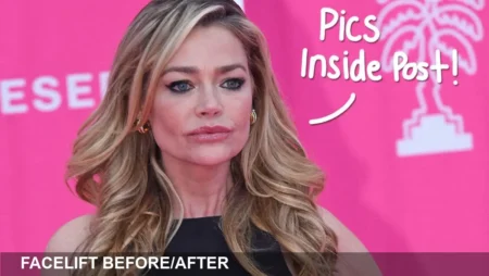 Denise Richards Shares Dramatic Facelift Before/After