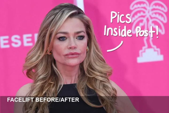 Denise Richards Shares Dramatic Facelift Before/After